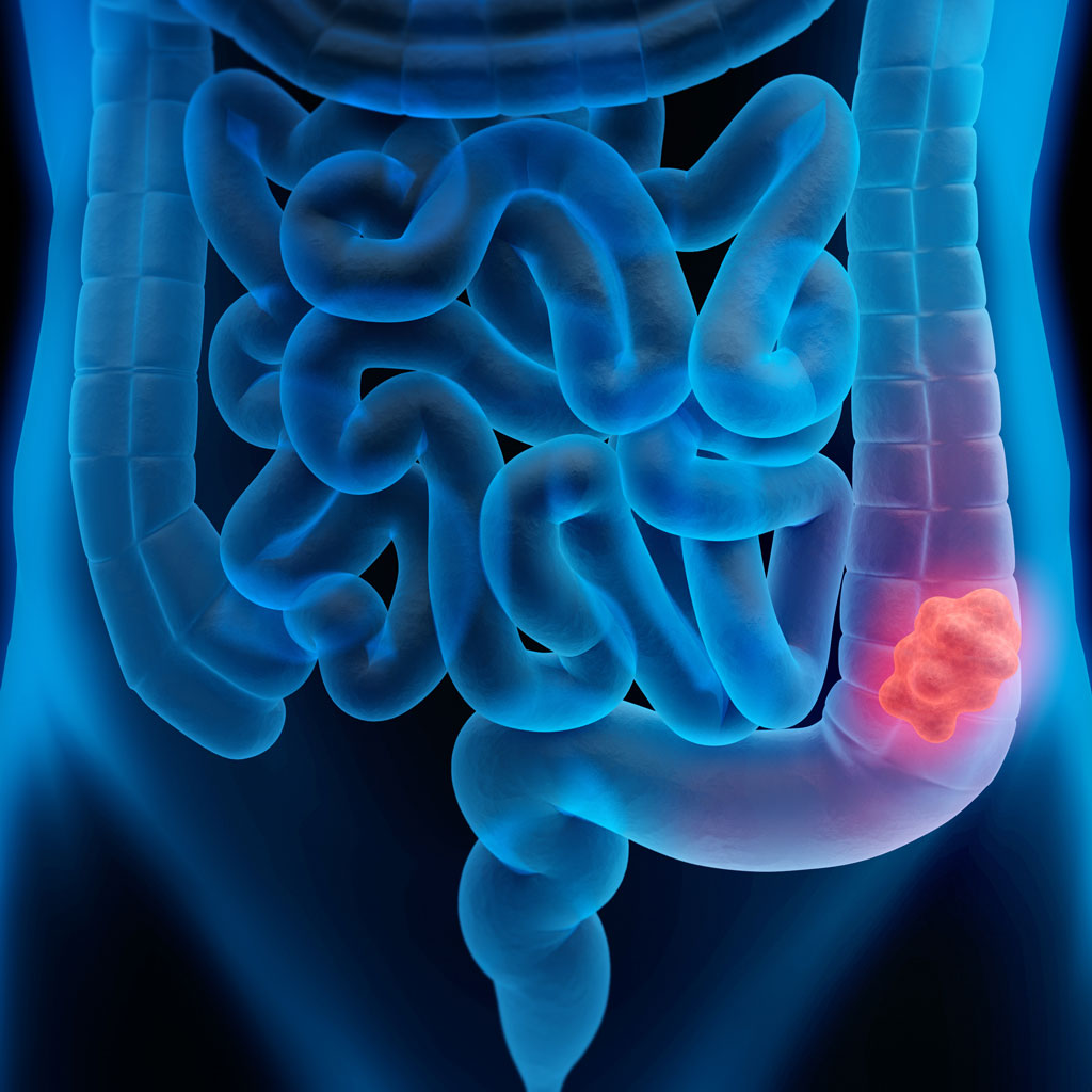 Colon Cancer Illustration