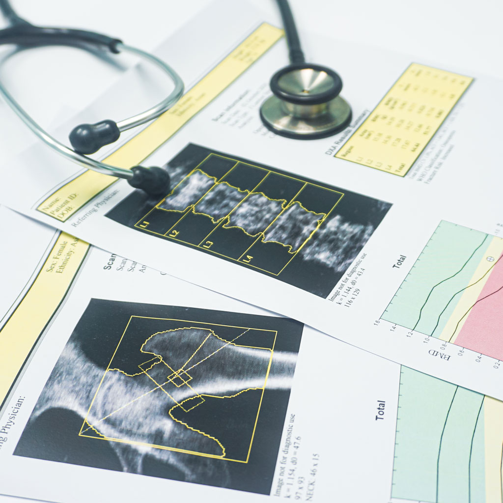 DEXA Bone Scan Results