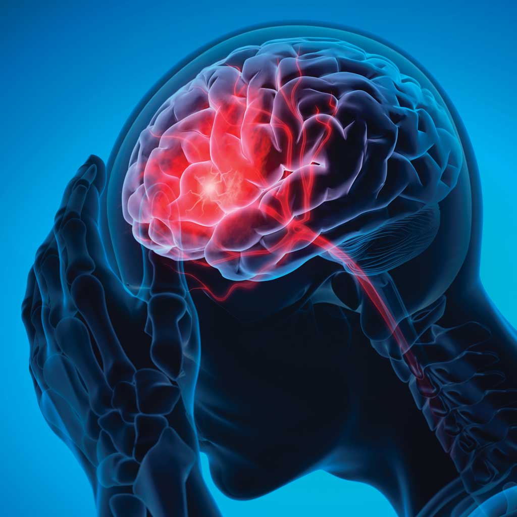 Stroke Brain Render