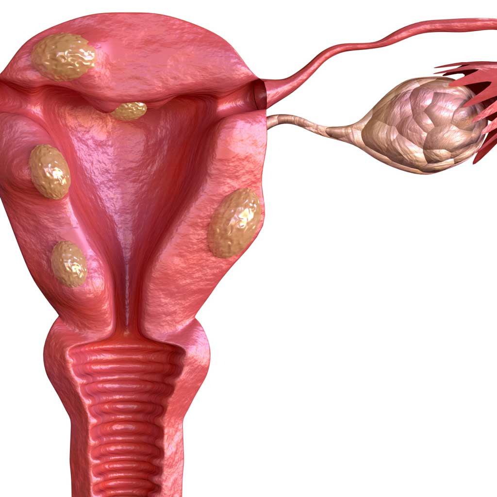 Uterine Fibroids 3D Render